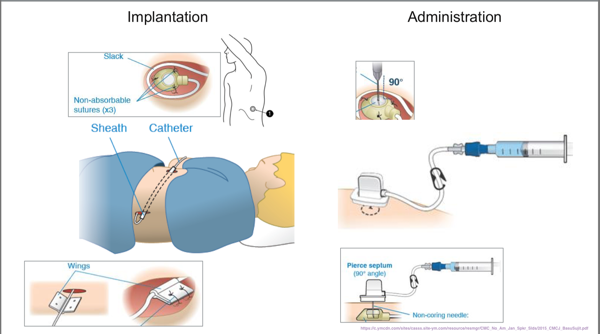 Intrathecal Port